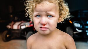 Toddler with curly blond hair and blue eyes, nose bleeding slightly, standing shirtless in a dim garage with cars in the background.