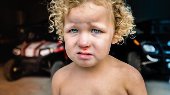 Toddler with curly blond hair and blue eyes, nose bleeding slightly, standing shirtless in a dim garage with cars in the background.