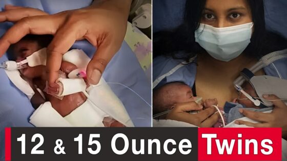 World’s Most Premature Twins: We Believed God for a Miracle - Family & Relationships, Pregnancy Complications, Testimonies - 100huntley